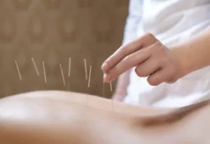 Acupuncture Therapy Downtown